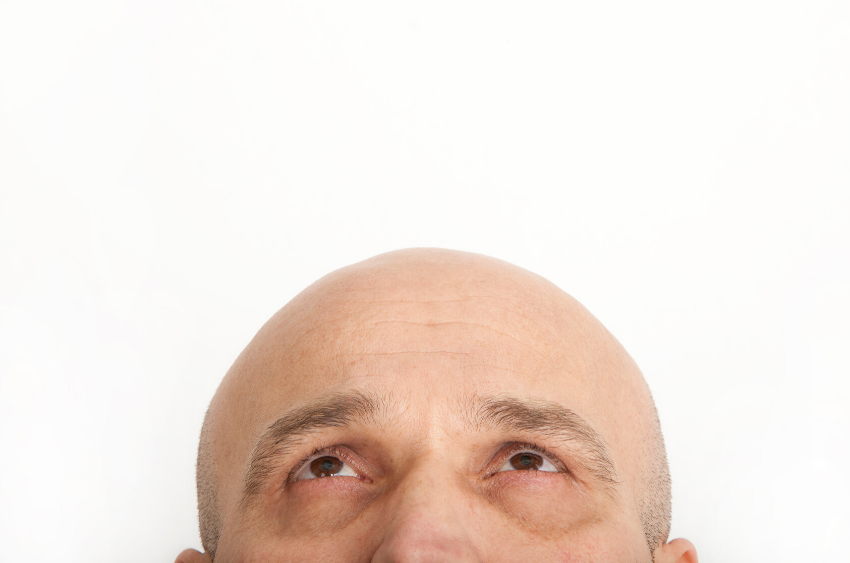 Debunking 13 Myths About ‘The Baldness Gene’