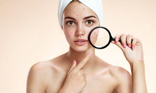 WHAT IS THE ROOT CAUSE OF ACNE? WHY DO SOME PEOPLE HAVE IT MORE?