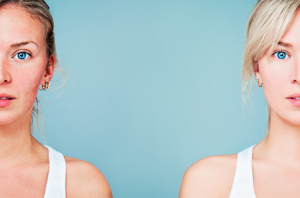 Health Benefits of Fermented Foods That Can Solve Your Acne Problems